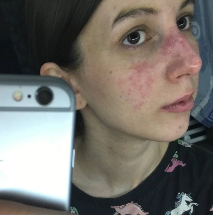 Anastasiia, during an early rosacea flare, before she understood what it was